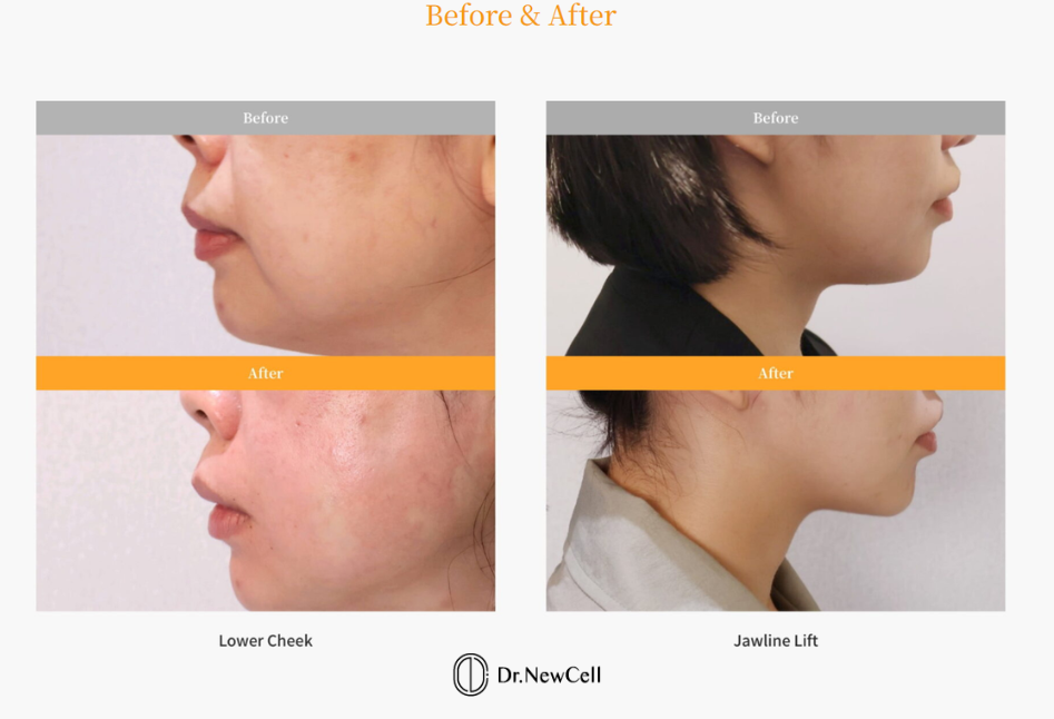 ultherapy vs ultherapy prime