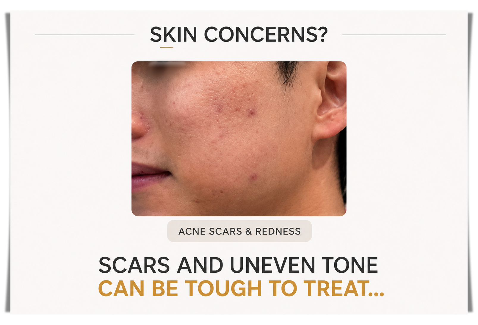 Potenza Pore Treatment Patient