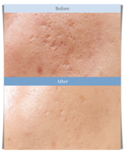 Large Pore Treatment Laser