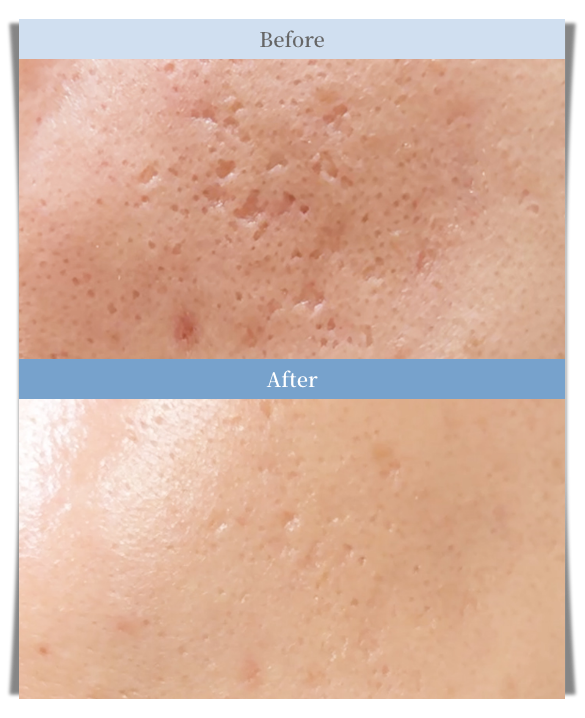 Potenza Pore Treatment Before and After