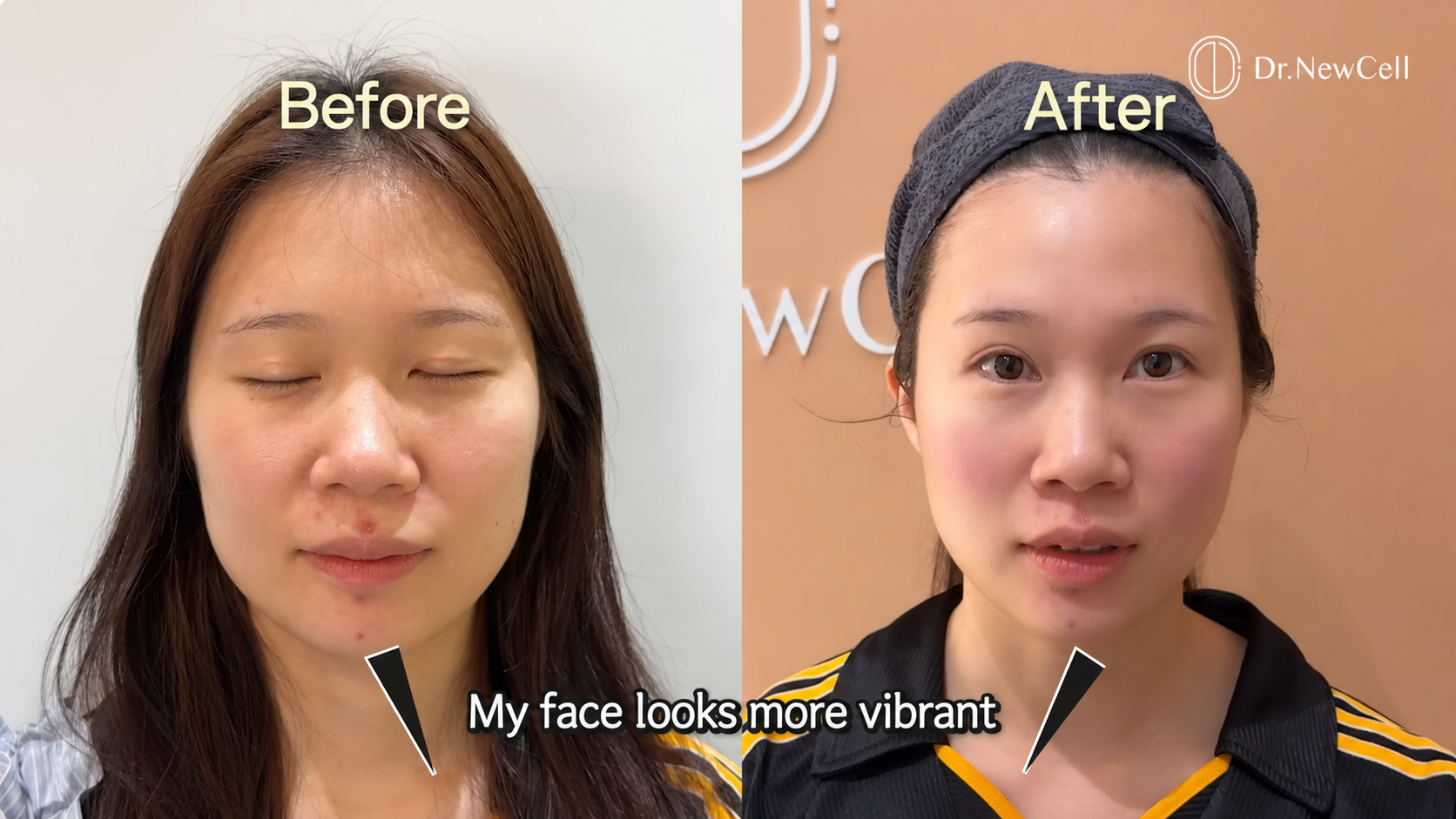 Before and after of face lifting treatment