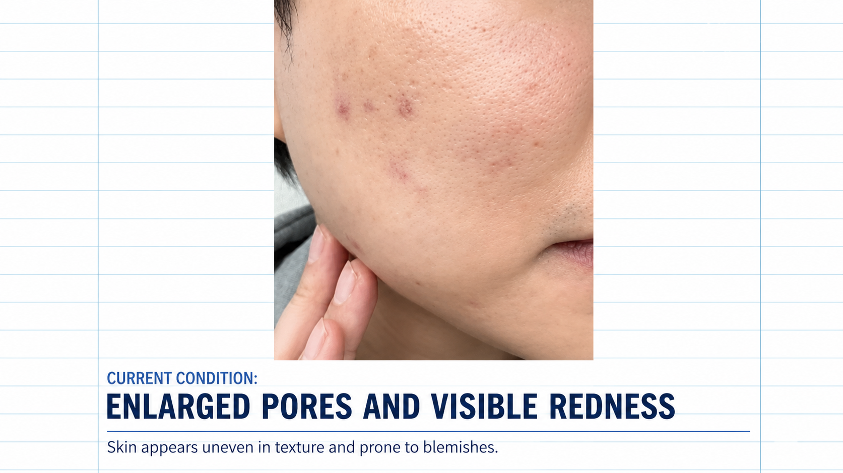 potenza RF microneedling large pores and visible redness 