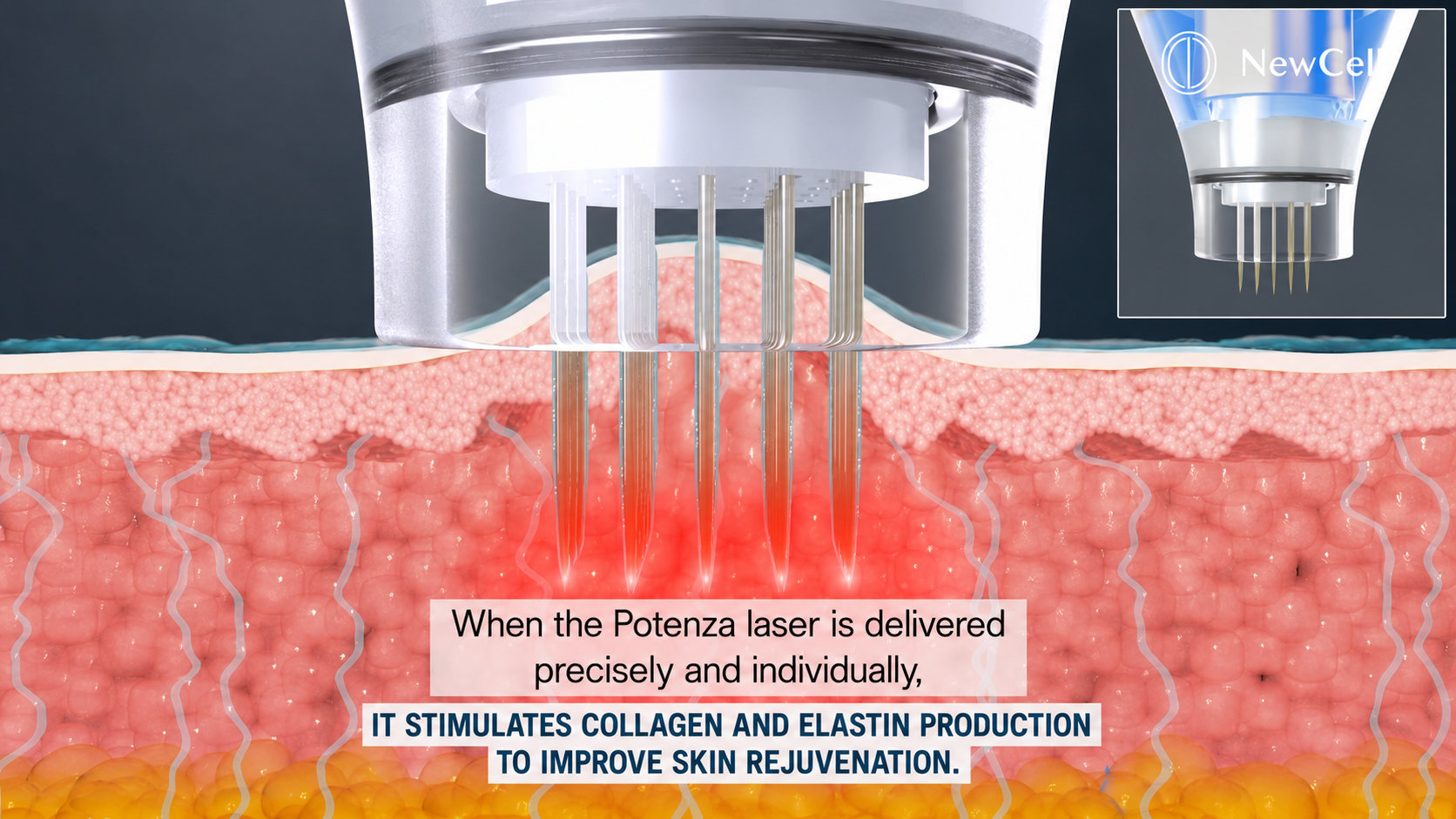 how potenza RF microneedling works