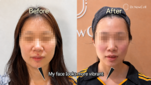 Before and after of face lifting treatment