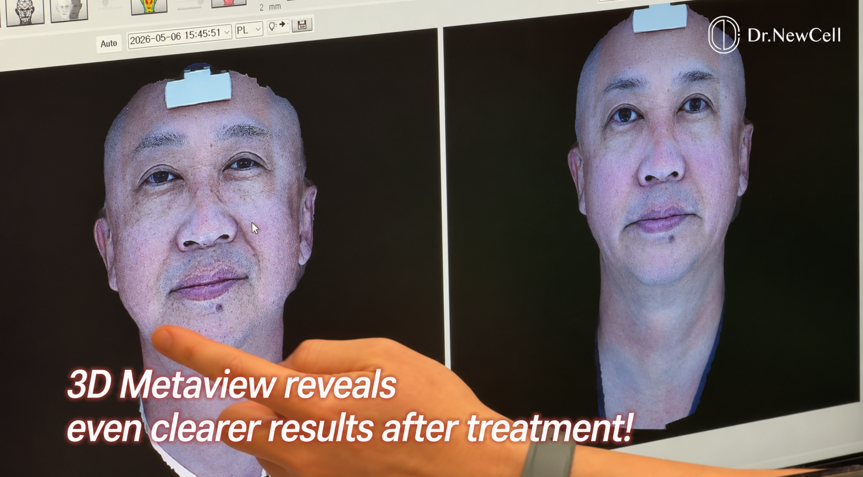The result of Skin Analysis Seoul, Meta-Vu