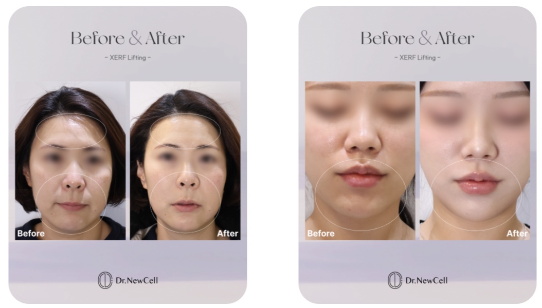Facelift Treatments in Korea skin clinic gangnam