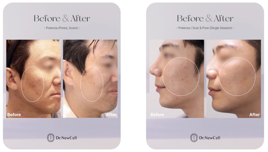 skin clinic gangnam Potenza Treatment