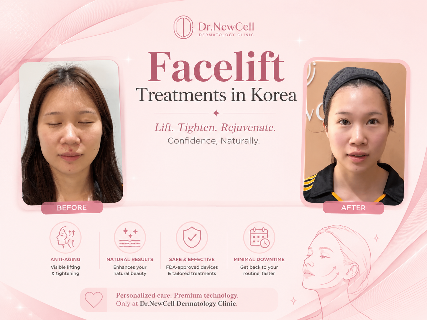 Face Lifting Treatment in Seoul