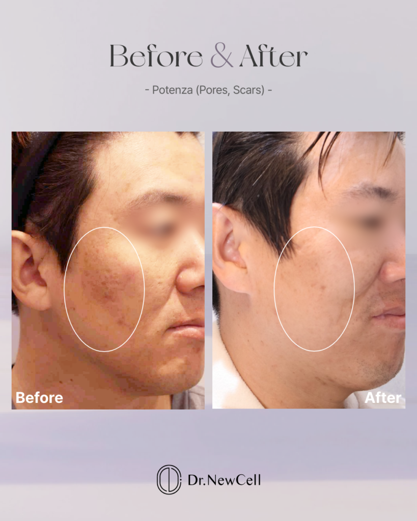 Where to get Potenza treatment for skin texture in Gangnam
