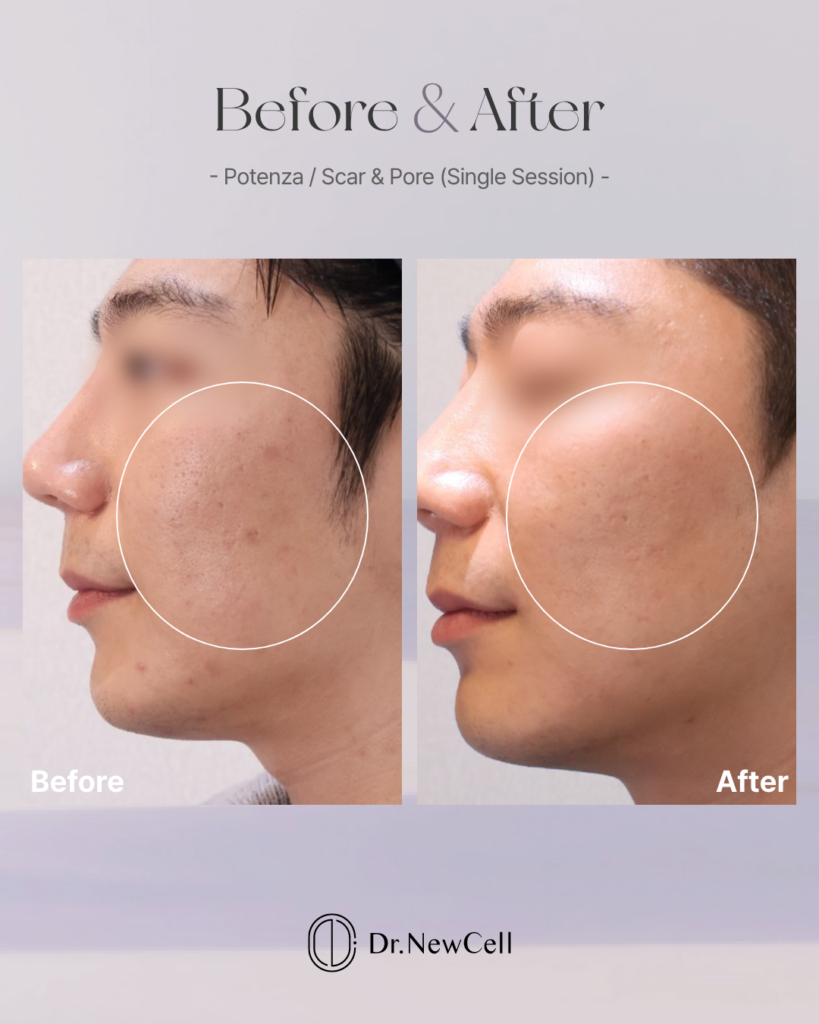 Where to get Potenza treatment for skin texture in Gangnam