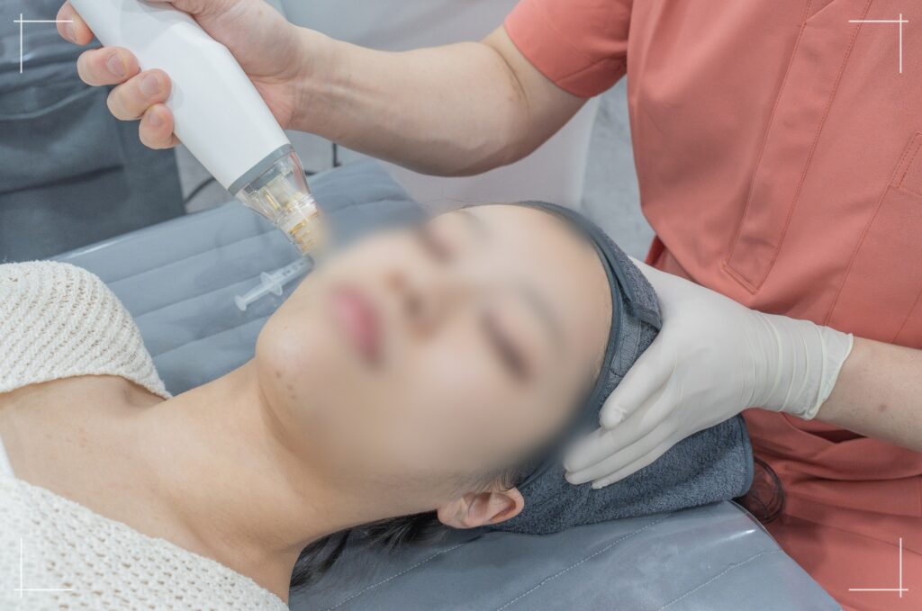 닥터뉴셀의원 포텐자 펌핑팁 시술 모습