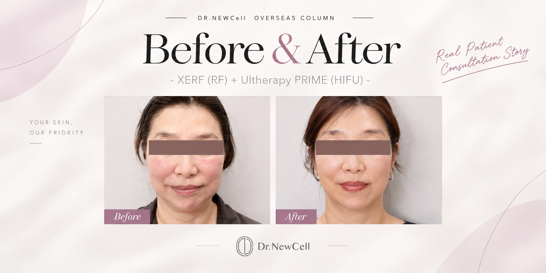 The Ultimate Guide to Skin Tightening Treatments in Korea Top 5