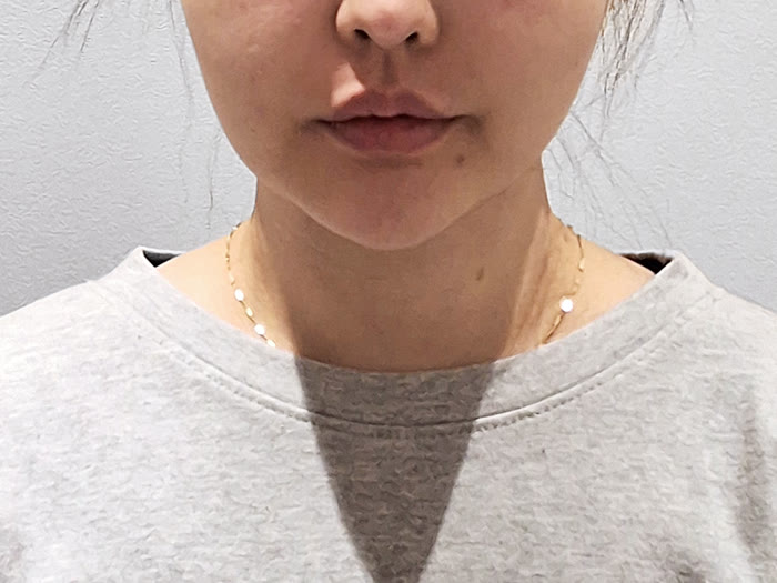 オールタイト リフティング施術前、30代女性の正面、頬のたるみとハリ低下