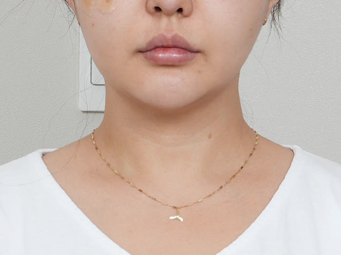 オールタイト リフティング施術2週間後、30代女性の正面、顔全体のハリが改善