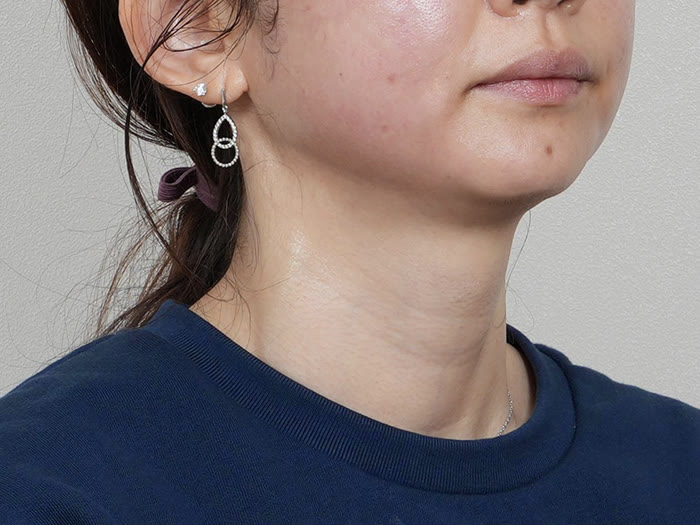 オールタイト リフティング施術直後、30代女性の側面、あごのラインがはっきり