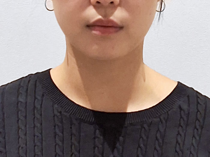 オールタイト リフティング施術前、30代女性の正面