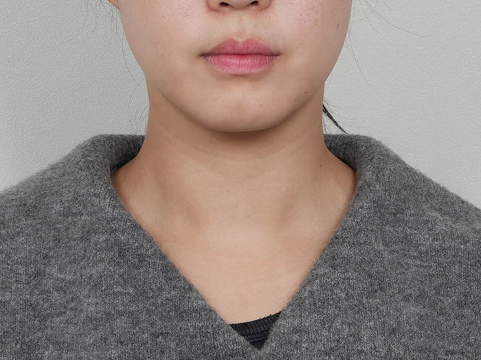 オールタイト リフティング施術10日後、30代女性の正面、頬のラインが整う