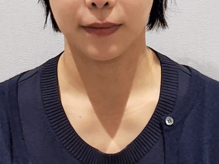 オールタイト リフティング施術前、30代女性の正面、ほうれい線上のたるみ