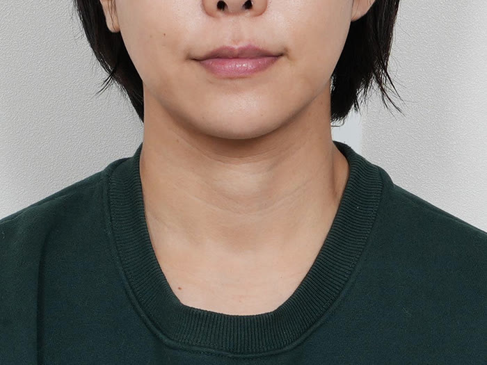 オールタイト リフティング施術2週間後、30代女性の正面、ほうれい線周辺と頬のラインが改善