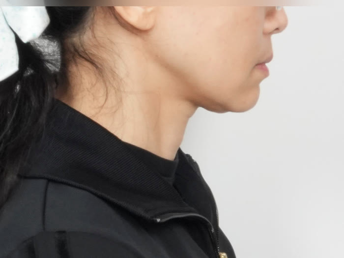 オールタイト リフティング施術前、40代女性の側面、頬・あごのたるみ