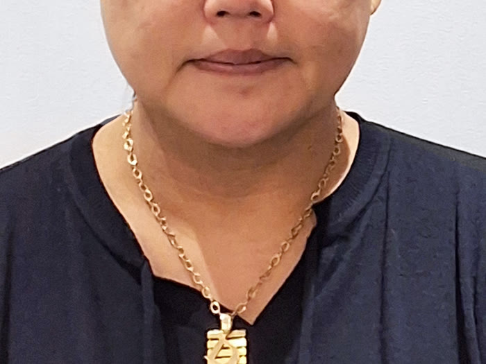 オールタイト リフティング施術前、50代女性の正面、頬とフェイスラインのたるみ
