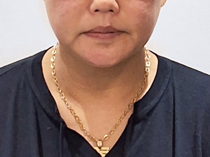 オールタイト リフティング1回施術直後、50代女性の正面、フェイスラインが整い頬が上がる