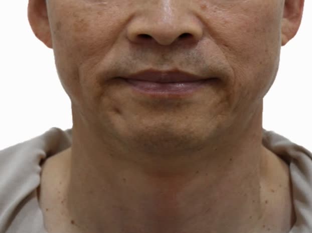 オリディアマヨ施術前、中年男性の正面（目の下からトリミング）、頬のたるみとほうれい線