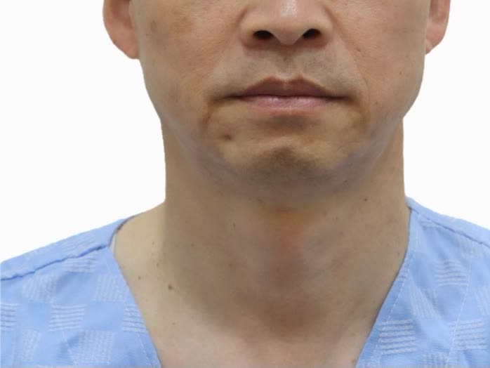 オリディアマヨ施術後、中年男性の正面（目の下からトリミング）、頬のラインとキメが改善