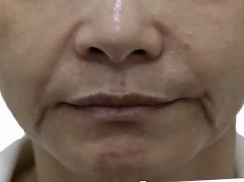 オリディアマヨ施術前、中年女性の正面（目の下からトリミング）、頬のたるみとほうれい線