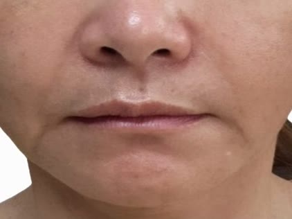 オリディアマヨ施術後、中年女性の正面（目の下からトリミング）、頬のボリュームとハリが改善