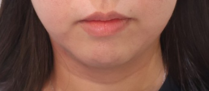 XERF施術後、二重あごが目立たなくなり、あご下のラインが整った様子（鼻下でトリミング）