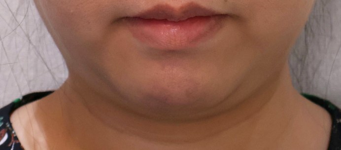 XERF施術前、あご下の二重あごとたるんだ皮膚（鼻下でトリミング）