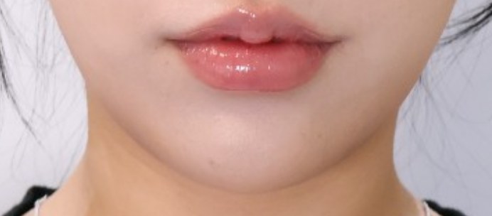 XERF施術後、フェイスラインの輪郭がすっきりした様子（鼻下でトリミング）
