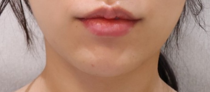 XERF施術前、ぼやけたフェイスライン（鼻下でトリミング）