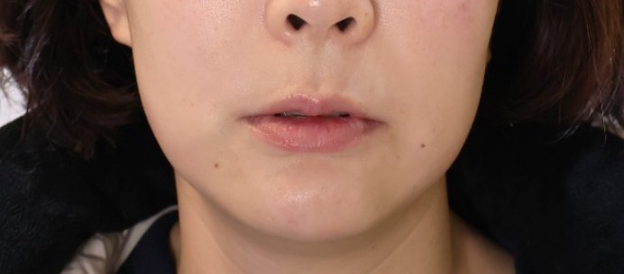 XERF施術後、口元のしわが薄くなりキメが整った様子（鼻下でトリミング）