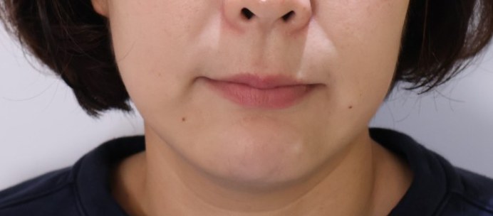 XERF施術前、口元とほうれい線まわりのしわ（鼻下でトリミング）