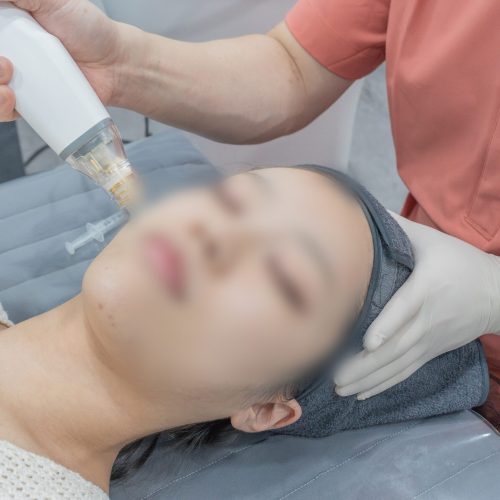 닥터뉴셀의원 포텐자 펌핑팁 시술 모습