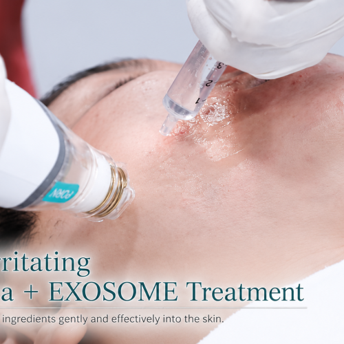potenza RF microneedling and exosome skin booster combination