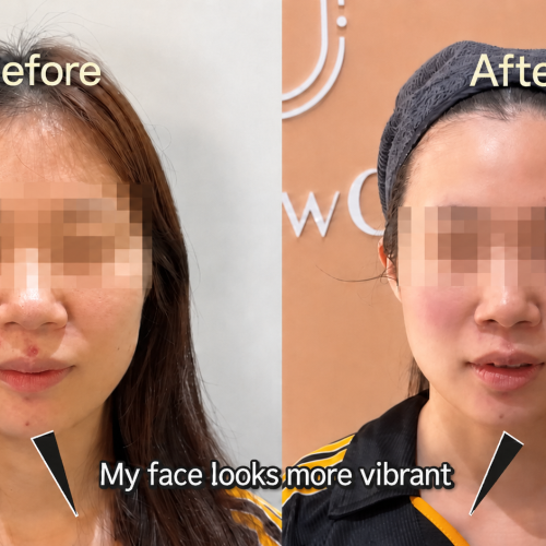 Before and after of face lifting treatment