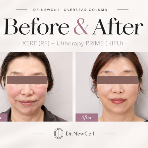 The Ultimate Guide to Skin Tightening in Korea Top 5