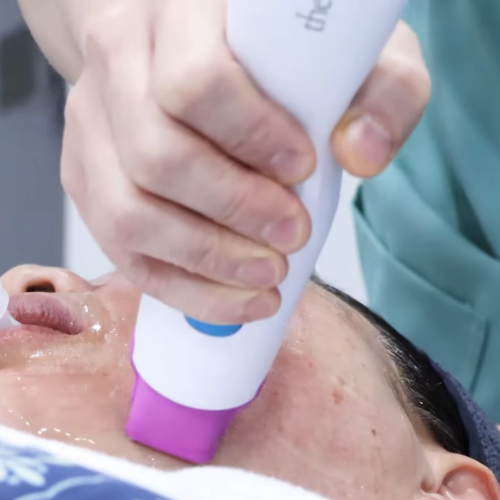 thermage for loose skin